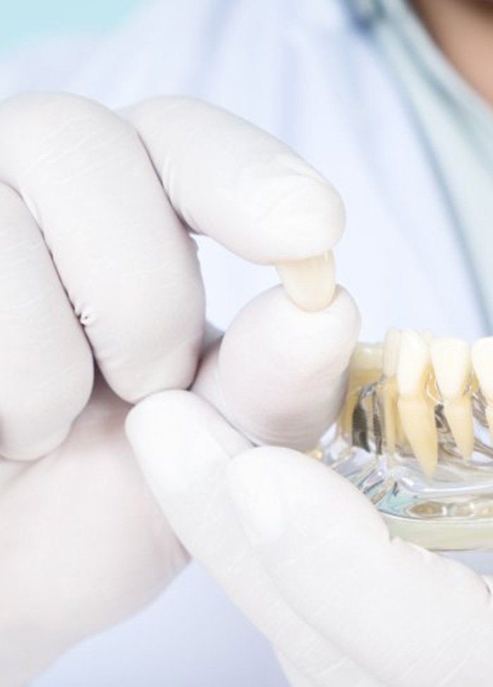 a dentist holding a model of a dental implant