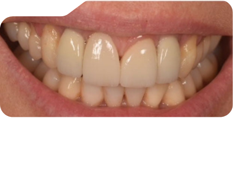 Close up of flawless teeth after treatment