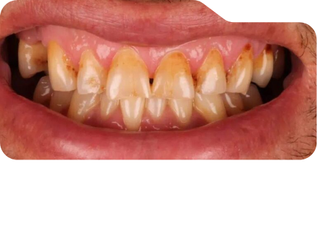 Close up of discolored teeth before treatment