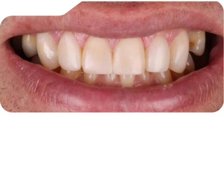 Close up of flawless teeth after treatment