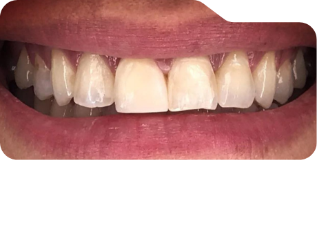 Close up of discolored teeth before treatment