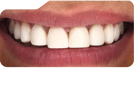 Close up of flawless teeth after treatment from Grand Prairie dentist