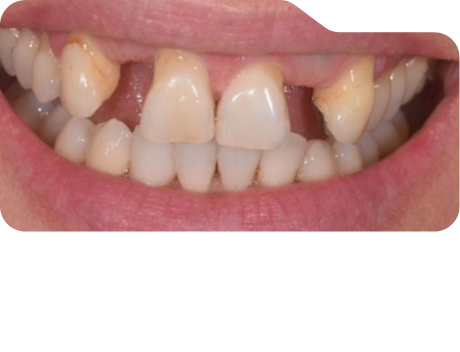 Close up of discolored teeth before treatment